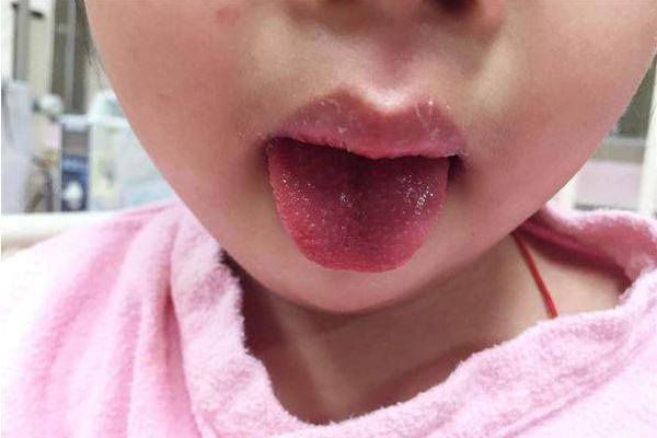 草莓舌苔是怎么回事 草莓舌怎么治疗
